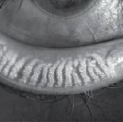 A black and white close-up of the textured skin on a person's lower eyelid and eyelashes.