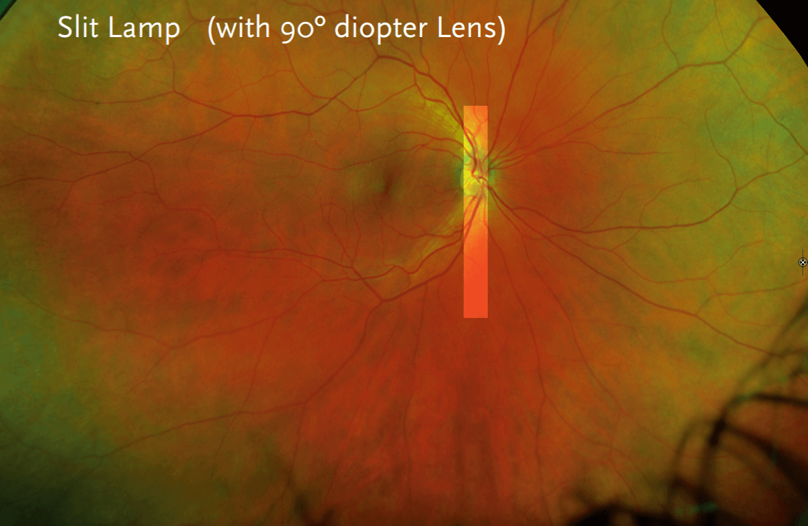 Close-up image of an eye's retina with text overlay 'Slit Lamp (with 90° diopter Lens)'.