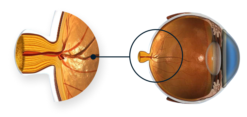 Schéma de l’anatomie de l’œil mettant l’accent sur le nerf optique.