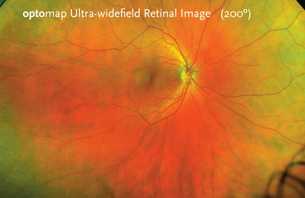 Ultra-widefield retinal image with visible blood vessels and optic nerve.