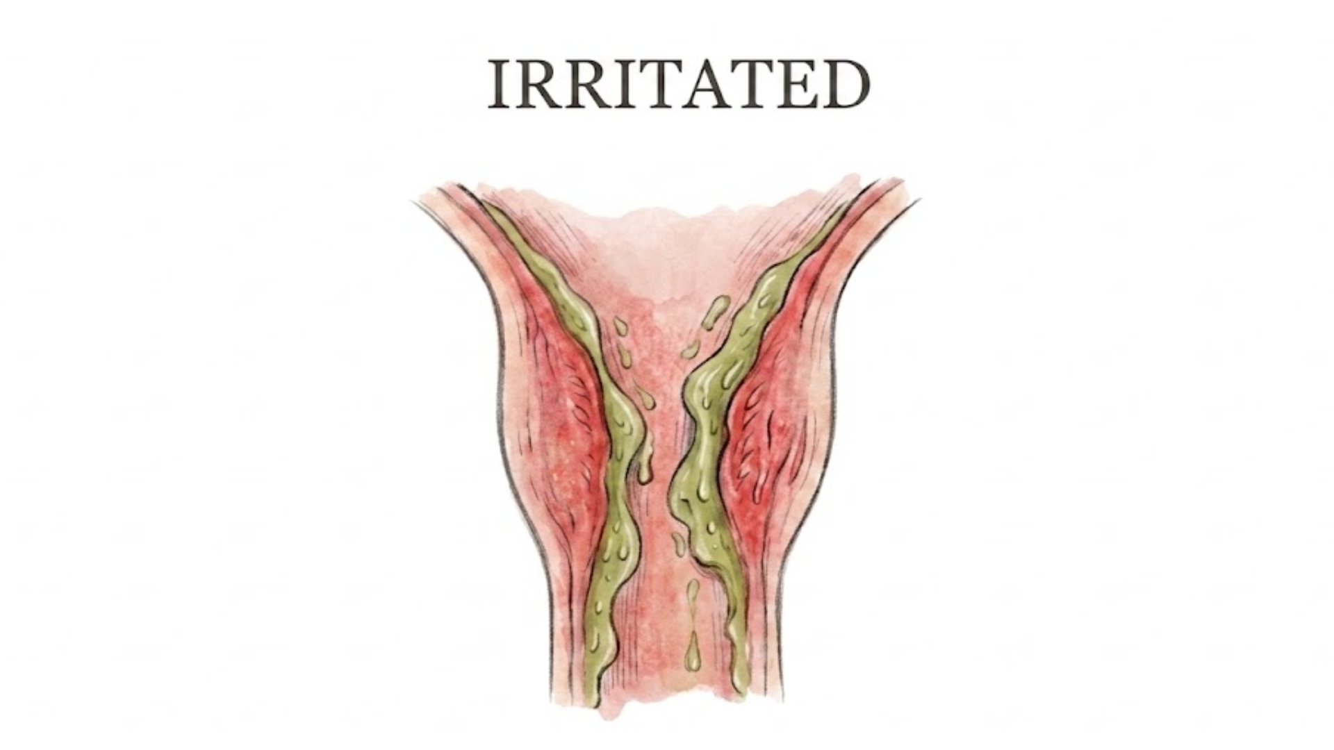 Anatomical illustration labeled 'IRRITATED' showing an inflamed internal passage with green discharge.