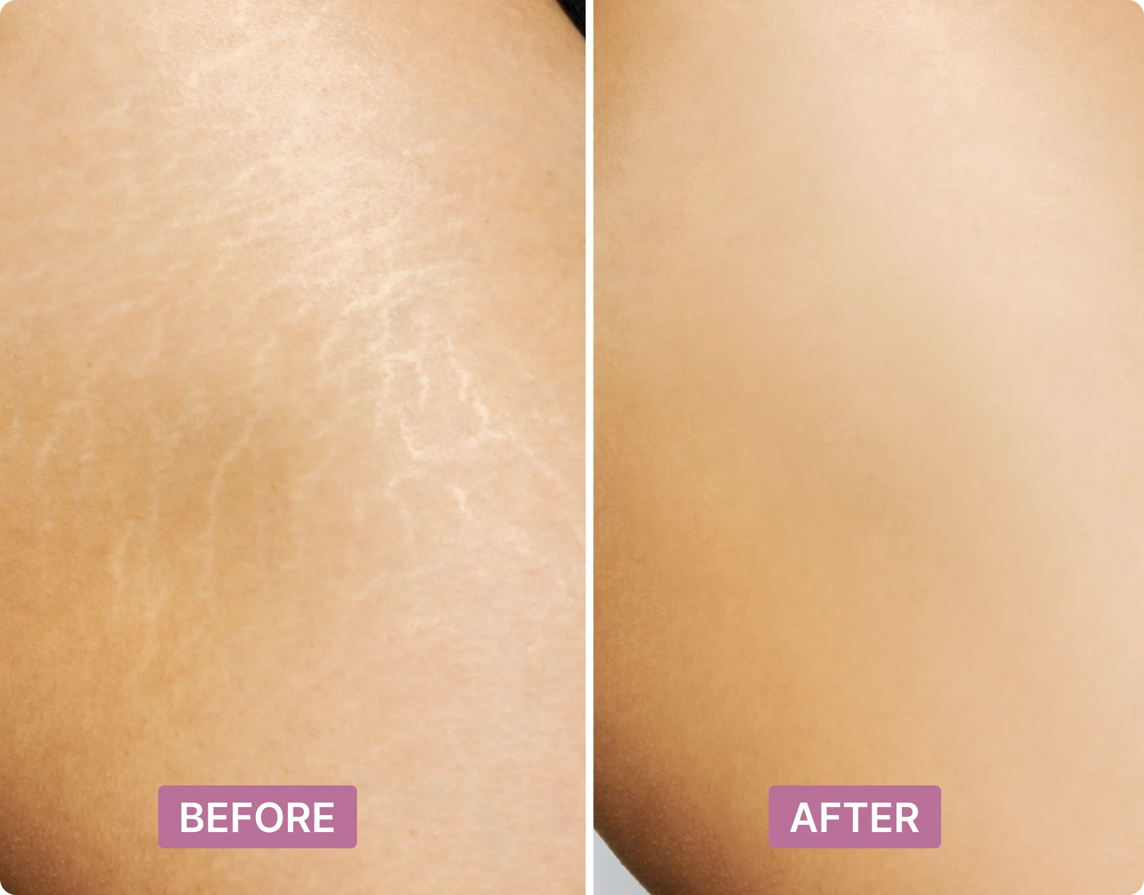 A before and after image showing the reduction of stretch marks on a person's skin.