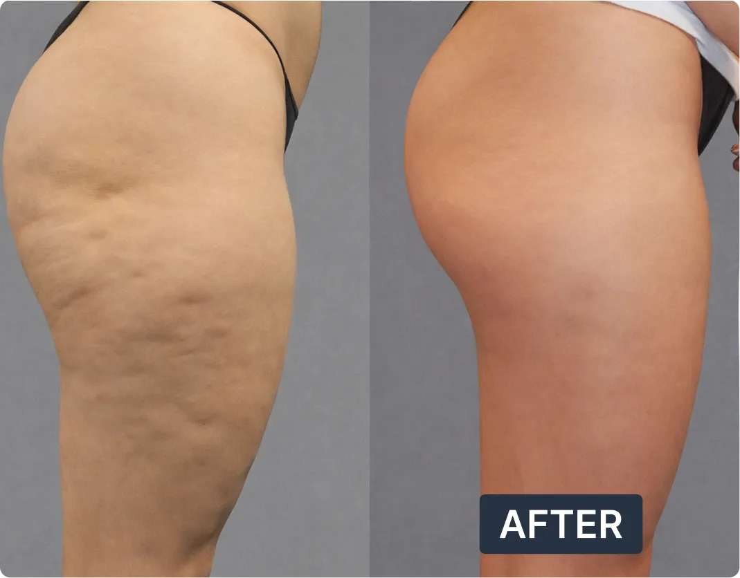 A before and after comparison of a woman's thigh and buttock, showing a reduction in cellulite.