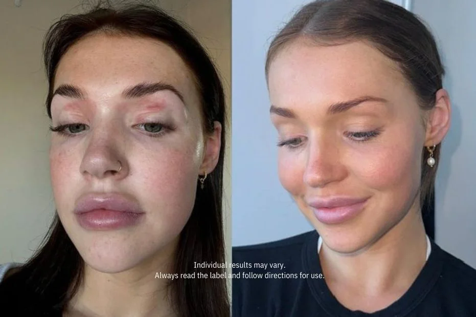 A before-and-after image of a woman's face, showing a reduction in skin redness and swelling.