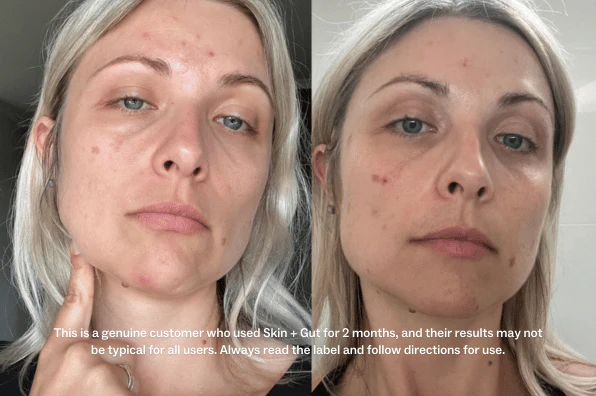 Comparison of woman's face showing skin improvement after product use.