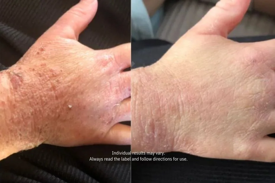 A before and after image showing a hand with a skin condition, with visible improvement on the right.