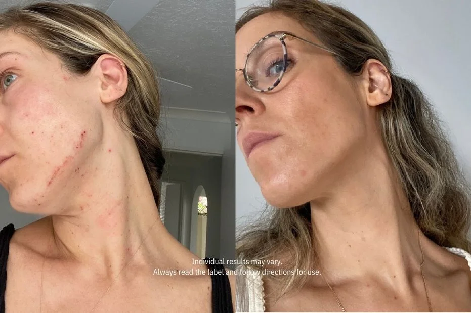 A before-and-after comparison showing improvement in a woman's skin condition on her face and neck.