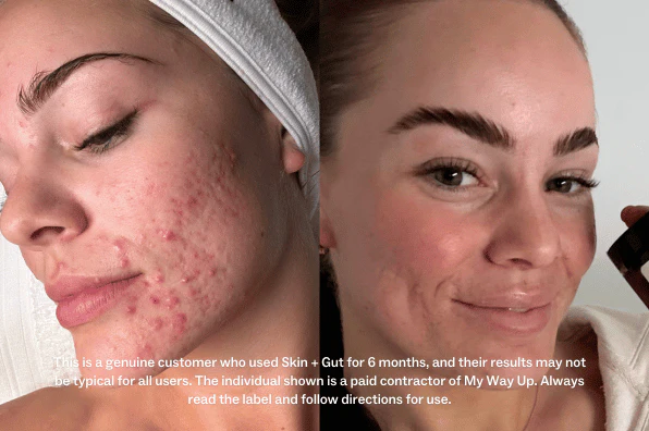 Side-by-side images showing skin improvement before and after treatment.