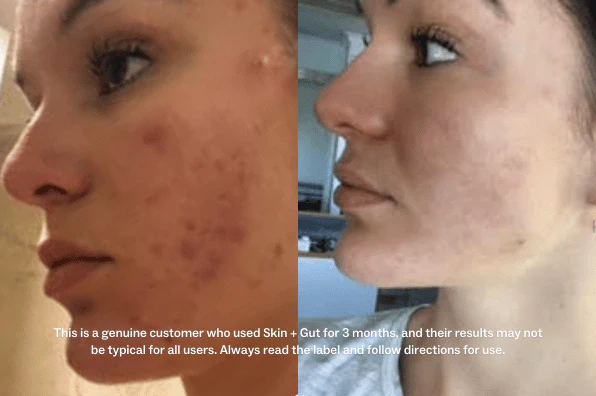 Side-by-side comparison of skin improvement on a woman's face before and after treatment.