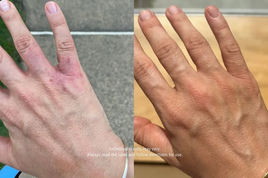 A before-and-after image showing a hand with a red skin condition on the left and the same hand cleared up on the right.