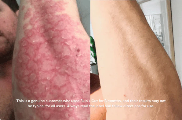 Side-by-side comparison of an arm before and after treatment.