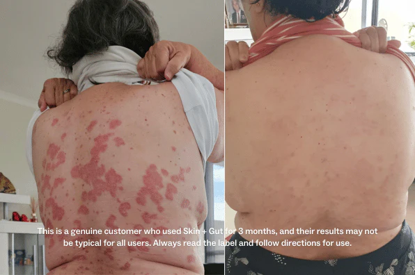 Two side-by-side images showing a person's back, before and after skin treatment.