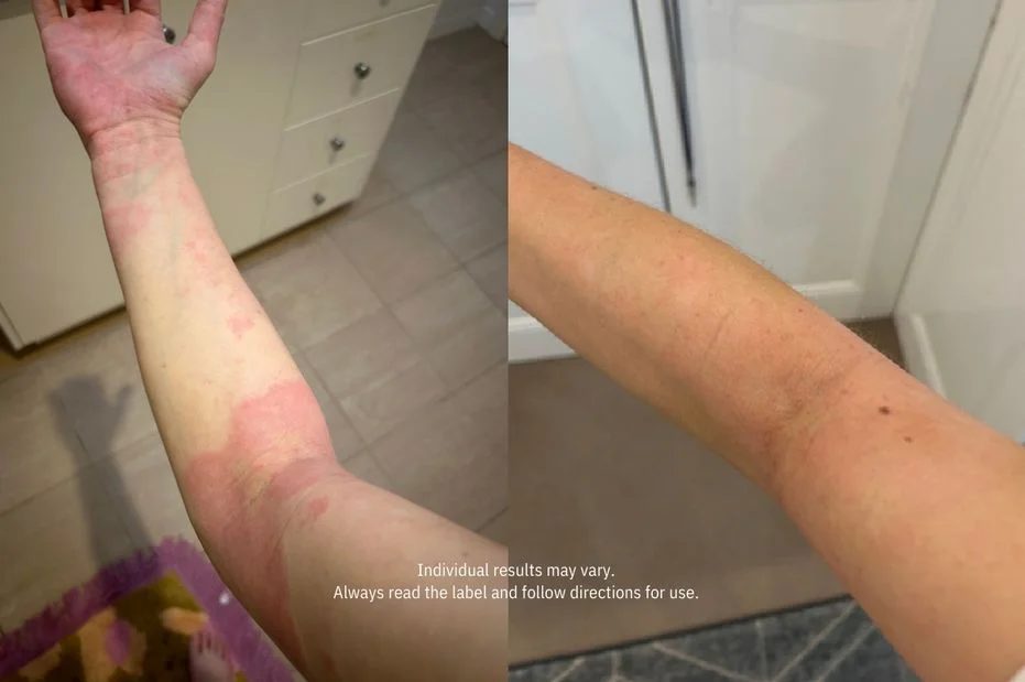 A before-and-after comparison showing a red skin rash on an arm that has visibly cleared up.
