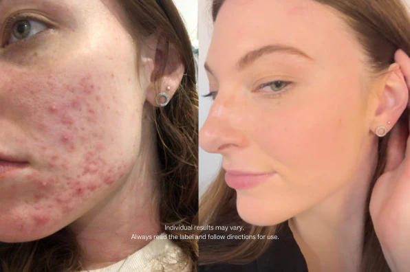 A before-and-after image showing a woman's facial acne on the left and clearer skin on the right.