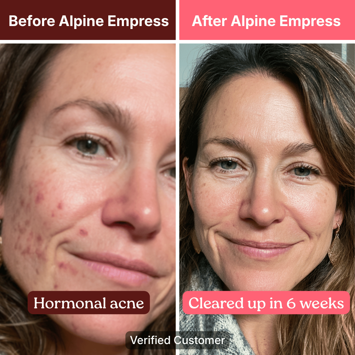 A before-and-after photo showing a woman's face with hormonal acne, and then with cleared-up skin after six weeks.