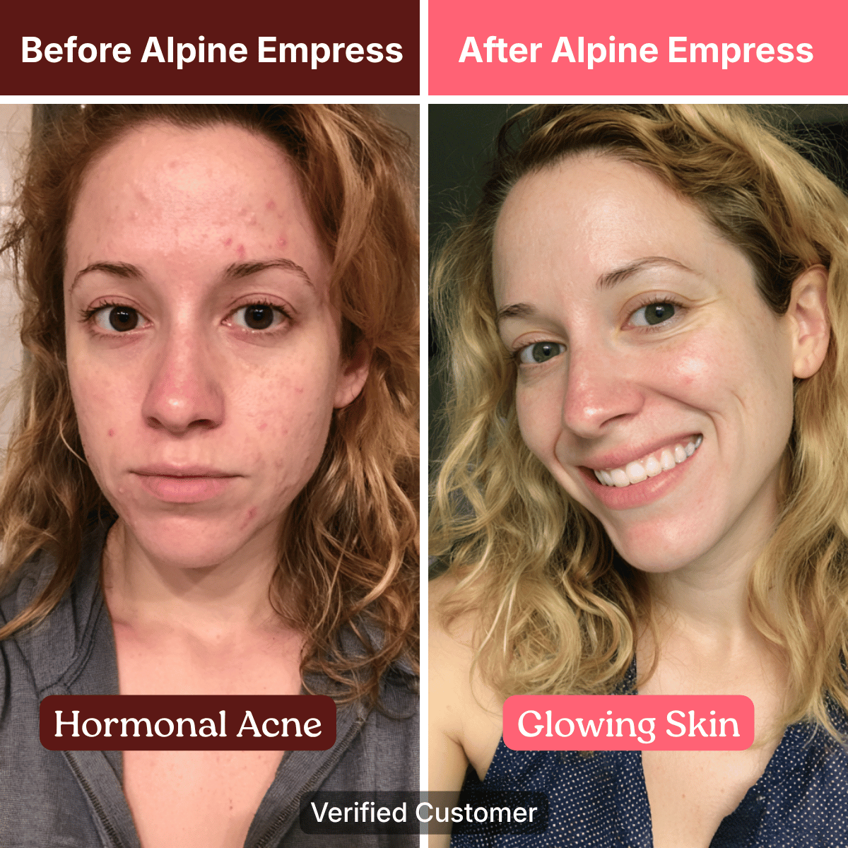A before and after comparison showing a woman's skin clearing up from acne to glowing and clear.