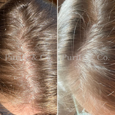 Side-by-side comparison of a scalp with and without dandruff.