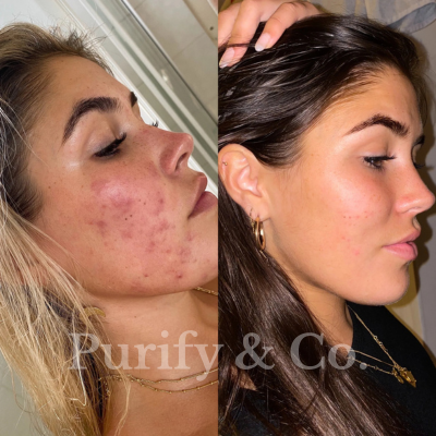 Side-by-side comparison of a woman's face before and after skincare treatment.