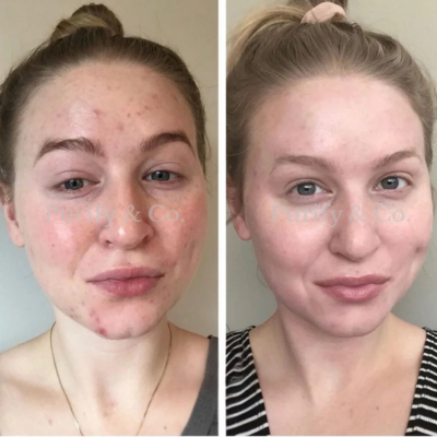 Side-by-side comparison of a woman's face before and after skincare treatment.