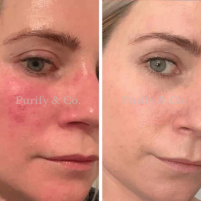 Side-by-side comparison of a woman's face with and without redness.