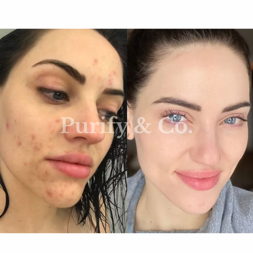 Side-by-side comparison of a woman's face with acne and clear skin.