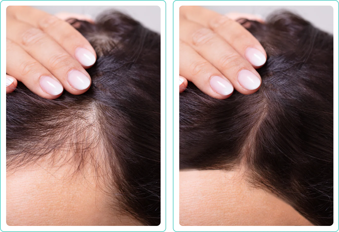 Two images showing a comparison of scalp with different hair coverage.