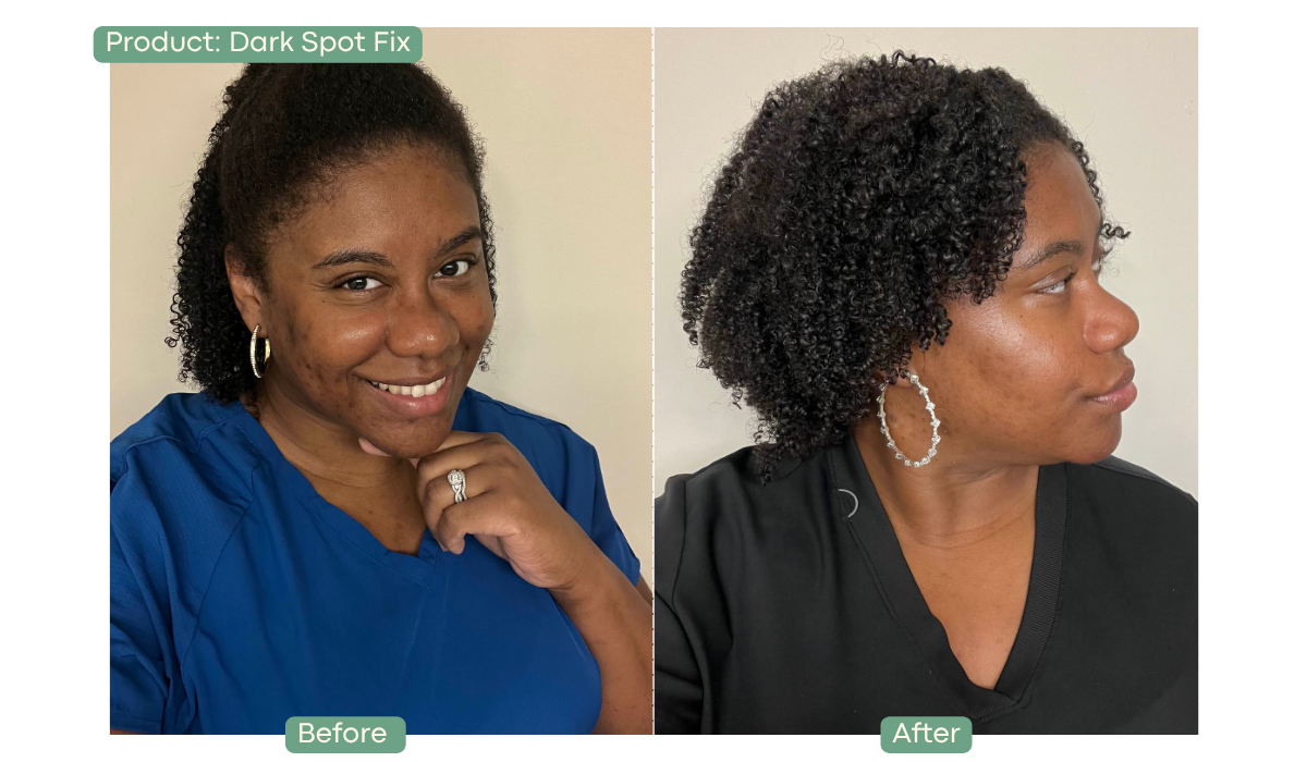 Before and after photos of a woman's face, showing a reduction in dark spots on her cheek.