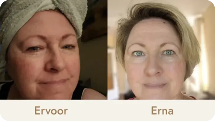Side-by-side comparison of a woman's face before and after a treatment.