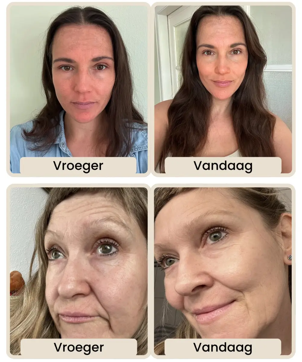 Comparison of two women's face photos labeled 'Vroeger' and 'Vandaag'.