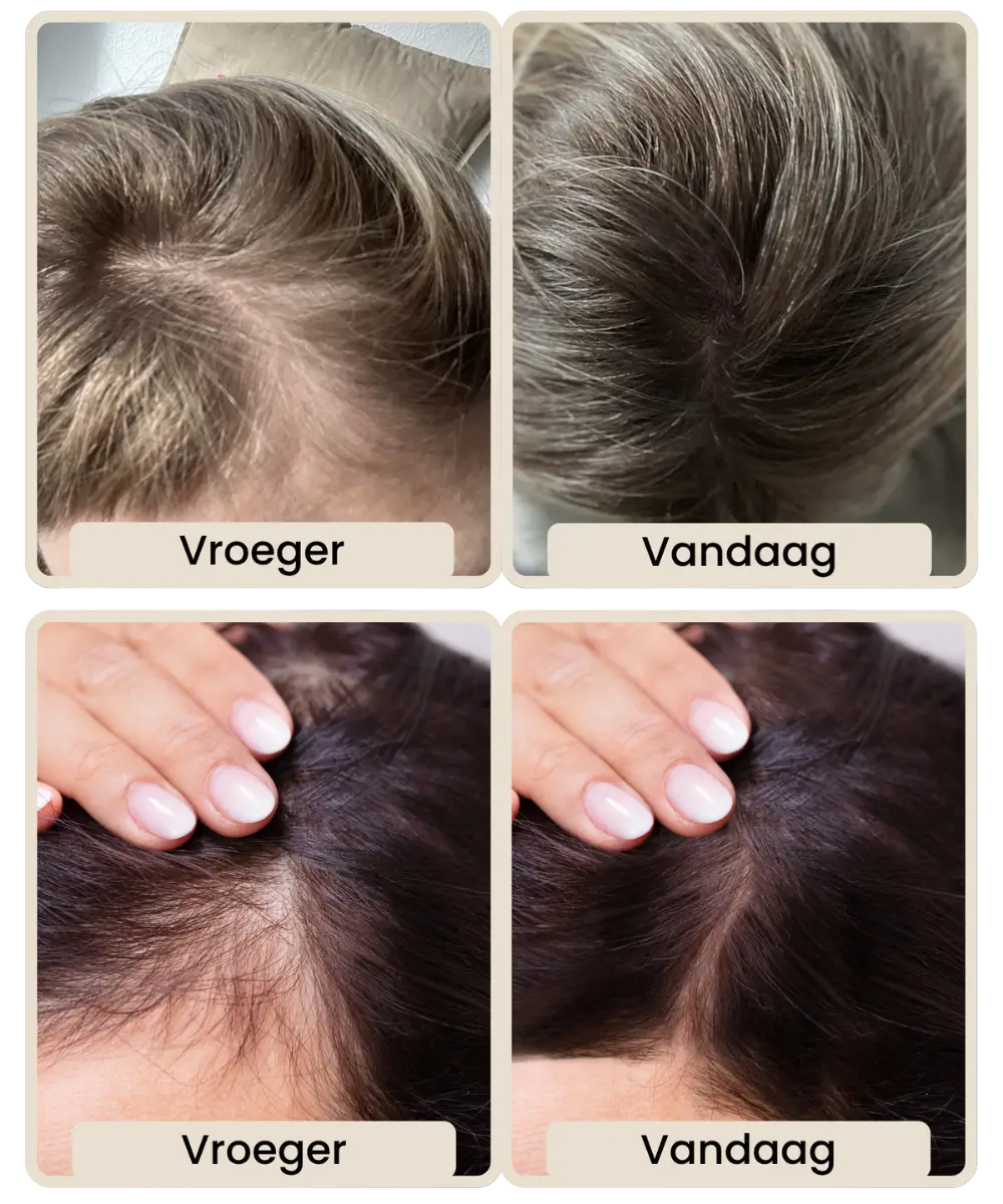 Comparison of hair thickness, labeled 'Vroeger' and 'Vandaag'.