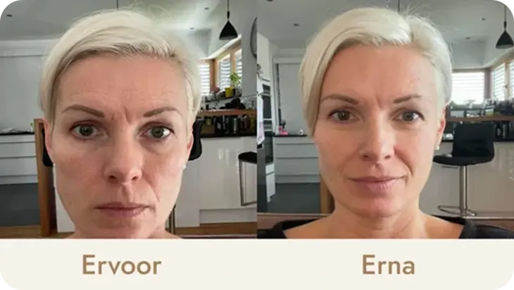 Side-by-side comparison of a woman's face before and after.