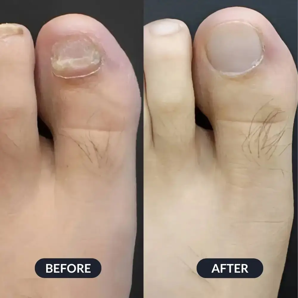 A before and after comparison of a big toe, with a damaged toenail on the left and a healthy one on the right.