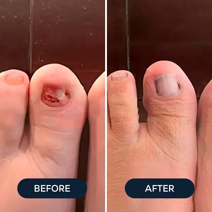 A before and after image showing a damaged big toenail that has healed and grown back.