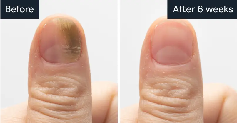 Comparison of a thumb nail before and after six weeks, showing improvement.