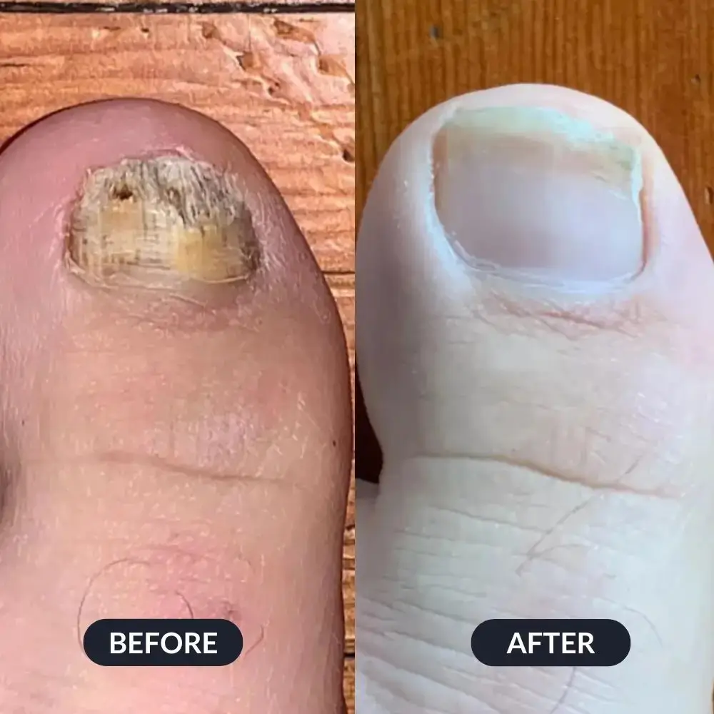 A before and after close-up of a big toe, showing a damaged, discolored toenail becoming healthy again.