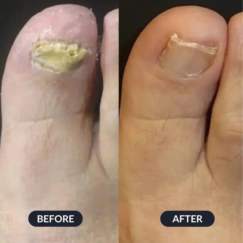 A before and after image showing the improvement of a damaged big toenail.