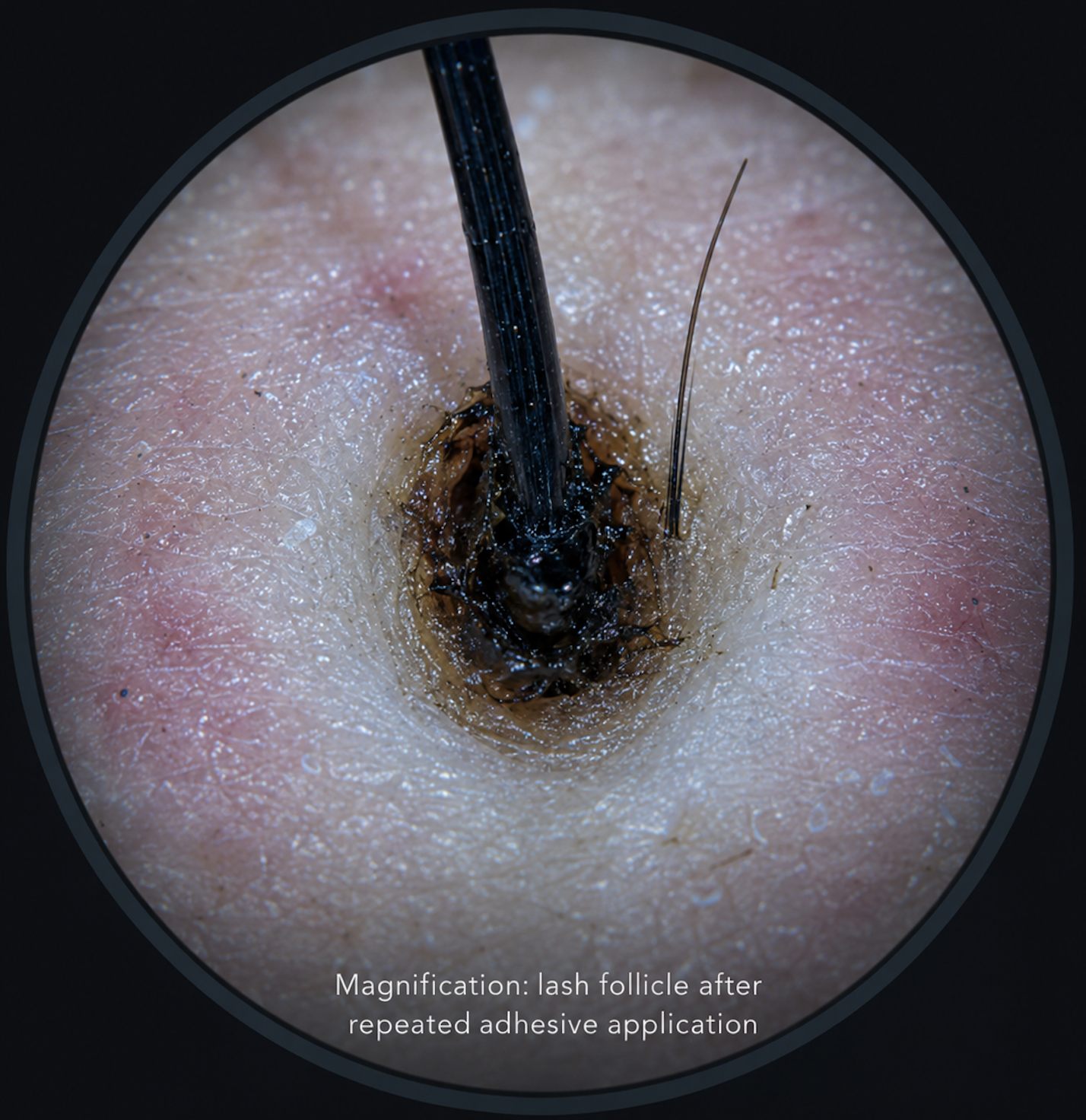 A magnified view of a lash follicle with dark residue from repeated adhesive application.