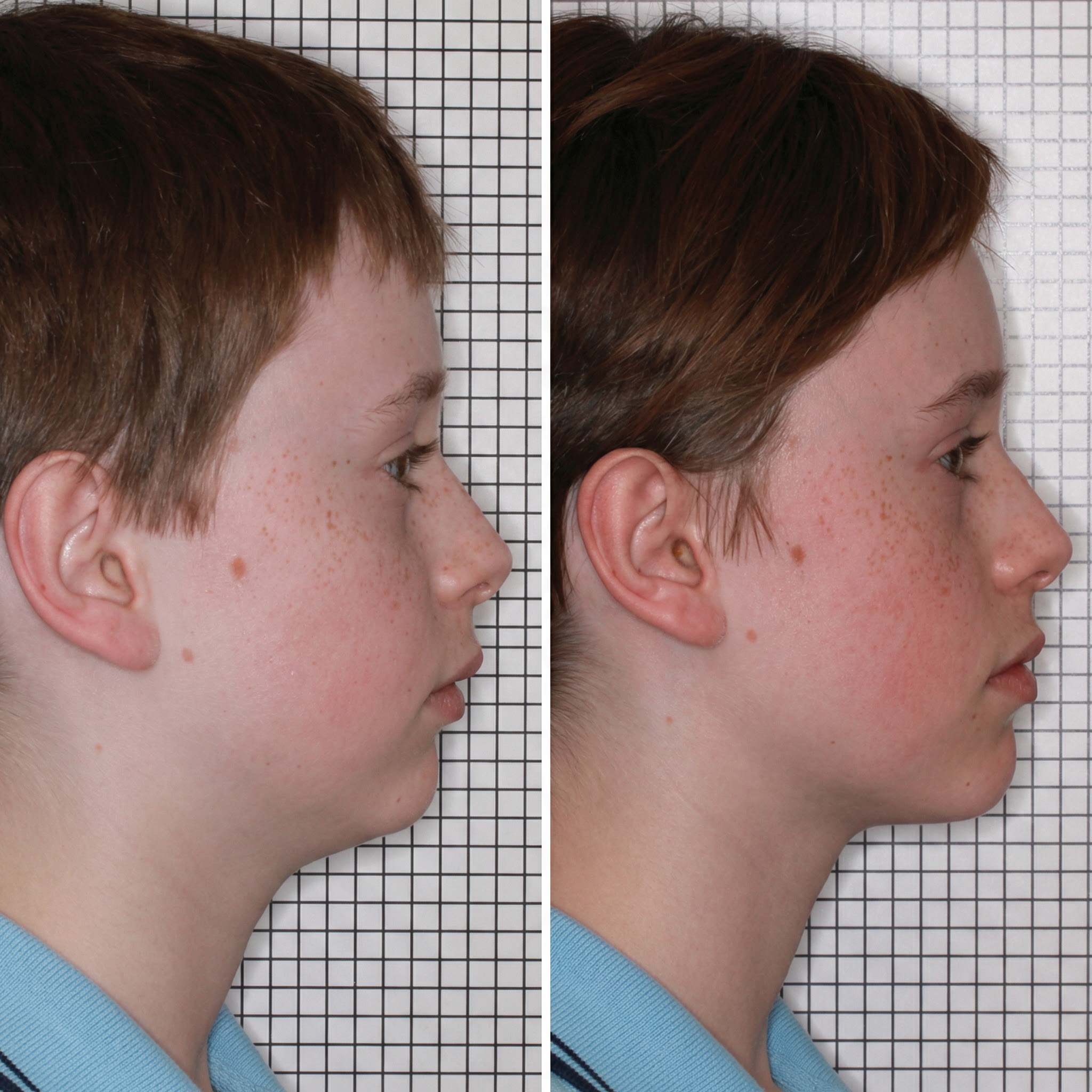 Before and after profile photos of a young boy, showing a change in his jaw and chin alignment.