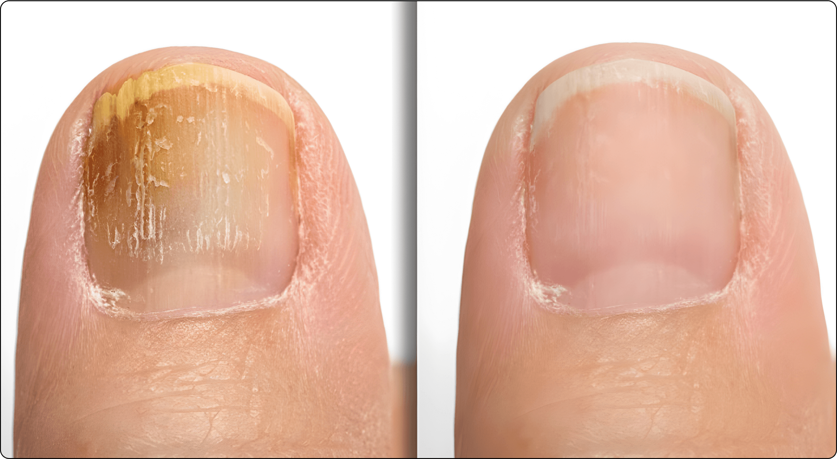Comparison of a toenail with fungal infection and a healthy toenail.
