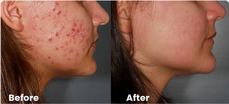 Side view of a woman's face showing acne before and clear skin after.