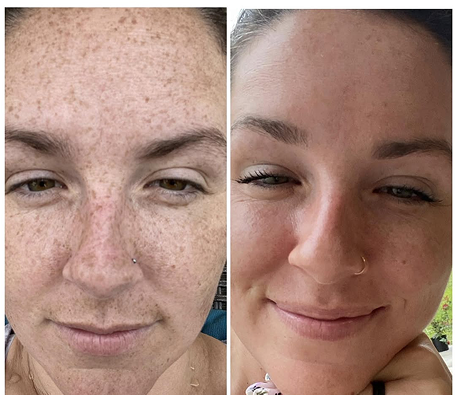 Side-by-side comparison of a woman's face with varying skin textures.