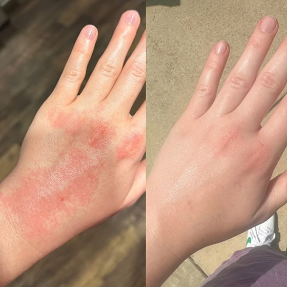 Two hands showing skin condition improvement, before and after treatment.