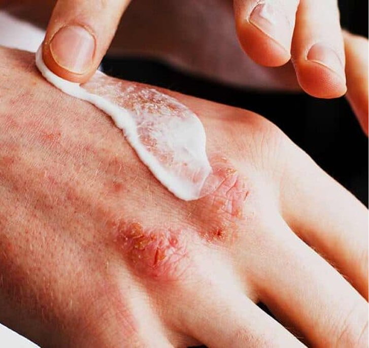 Hand with skin irritation being treated with cream.