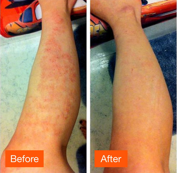 Comparison of a leg with skin irritation before and after treatment.
