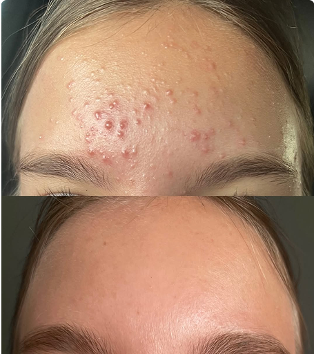 Side-by-side comparison of forehead acne before and after treatment.