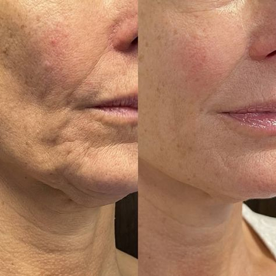Side-by-side comparison of facial skin texture before and after treatment.