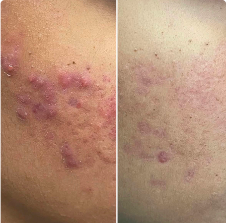 Two close-up images showing skin with raised red bumps.