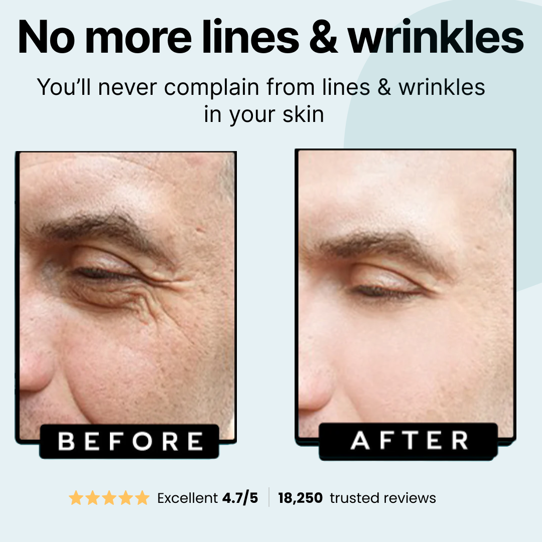 Side-by-side comparison of facial wrinkles before and after treatment.
