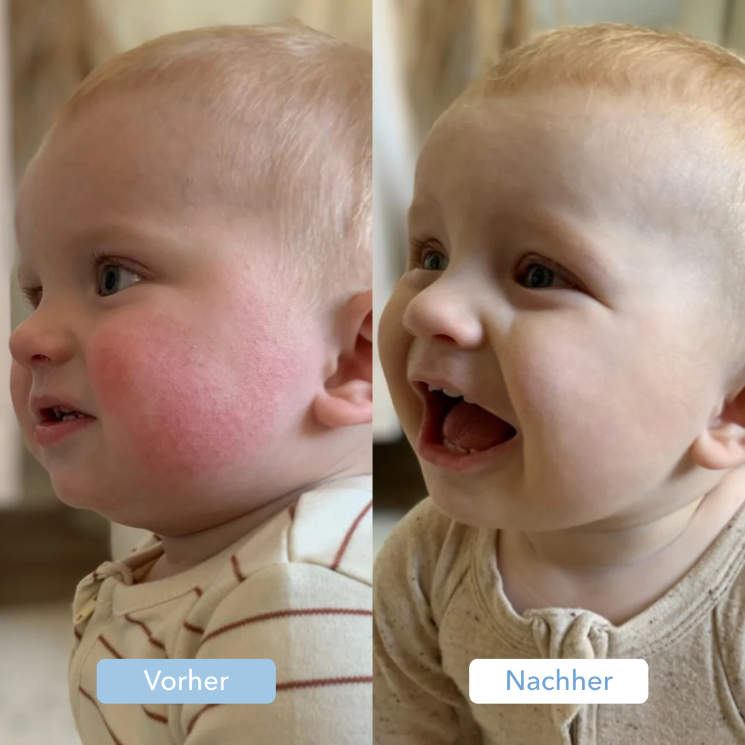 Side-by-side images of a baby before and after, showing skin improvement.