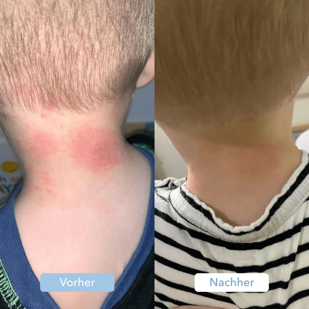 Side-by-side comparison of a child's neck before and after treatment.